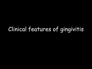 Clinical features of gingivitis

 