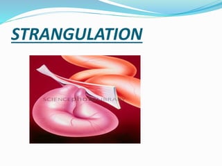 Clinical features of intestinal obstruction | PPTX