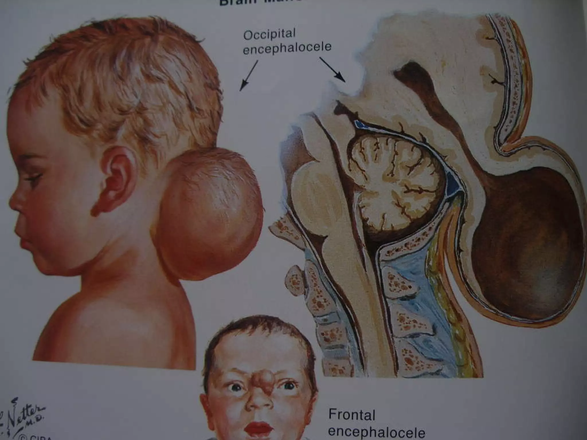 Clinical Features Of Neural Tube Defects | PPT