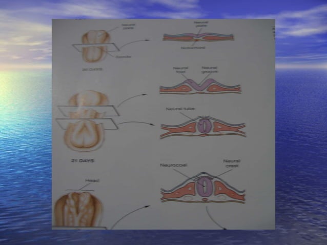 Clinical Features Of Neural Tube Defects | PPT