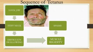 Clinical features of tetanus | PPTX