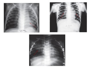 CLINICAL FORMS OF PAEDIATRIC TUBERCULOSIS.pptx