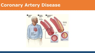 Coronary Artery Disease
 