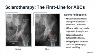 Comprehensive Assessment and Management of Benign Bone Tumours in ...