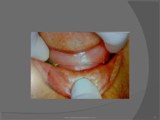 Clinical management of edentulous maxillectomy/ dentistry site