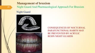 Management of bruxism
Night Guard And Pharmacological Approach For Bruxism
Night Guard
20
CONSEQUENCES OF NOCTURNAL
PARAFUNCTIONAL HABITS MAY
BE PREVENTED BY ACRYLIC
RESIN NIGHT GUARDS
 