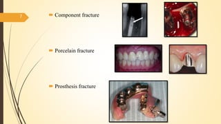  Component fracture
 Porcelain fracture
 Prosthesis fracture
7
 