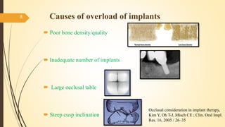 Causes of overload of implants
 Poor bone density/quality
 Inadequate number of implants
 Large occlusal table
 Steep cusp inclination
8
Occlusal consideration in implant therapy,
Kim Y, Oh T-J, Misch CE ; Clin. Oral Impl.
Res. 16, 2005 / 26–35
 