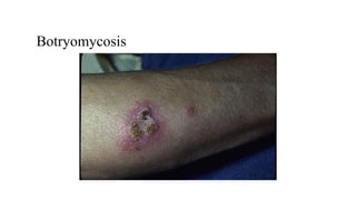 CLINICAL MANIFESTATION OF HIV AND MANAGEMENT- HOCCI.pptx