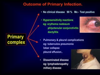 Guest Lecture: June 2013; Clinical manifestations of tuberculosis and ...