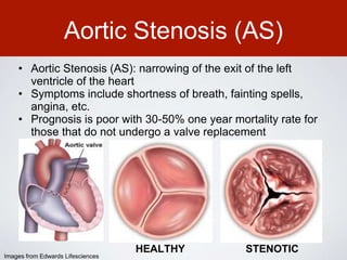 Aortic Stenosis (AS)
• Aortic Stenosis (AS): narrowing of the exit of the left
ventricle of the heart
• Symptoms include shortness of breath, fainting spells,
angina, etc.
• Prognosis is poor with 30-50% one year mortality rate for
those that do not undergo a valve replacement
HEALTHY STENOTIC
Images from Edwards Lifesciences
 