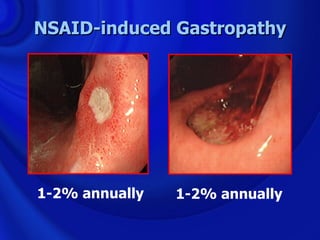 NSAID-induced Gastropathy




1-2% annually   1-2% annually
 