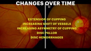 Comprehensive Clinical Evaluation of Optic Nerve Head in Glaucoma ...