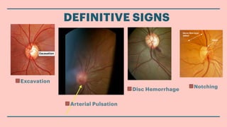Comprehensive Clinical Evaluation of Optic Nerve Head in Glaucoma ...