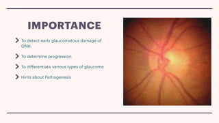 Comprehensive Clinical Evaluation of Optic Nerve Head in Glaucoma ...
