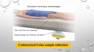 Catheterized Urine sample collection
 