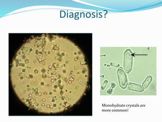 Diagnosis?
Monohydrate crystals are
more common!
 