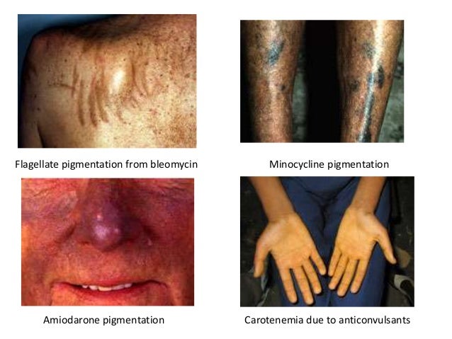 Comfrey as related to Cutaneous Drug Reactions - Pictures Comfrey as related to Cutaneous Drug Reactions - Pictures