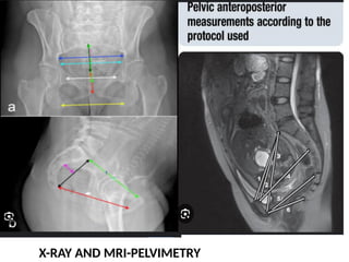INTRODUCTION TO CLINICAL PELVIMETRY.pptx