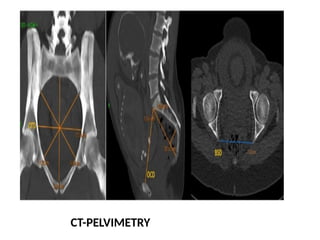 INTRODUCTION TO CLINICAL PELVIMETRY.pptx