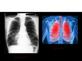 Emphysema
Bronchitis
 