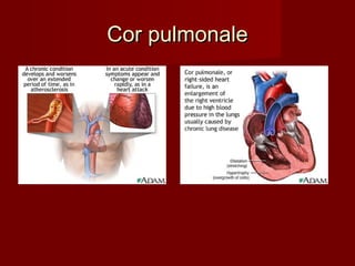 Cor pulmonaleCor pulmonale
 