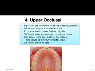 Palatal Retractor Clinical photography | PPTX