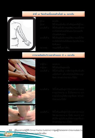 30 คู่มือแนวทางเวชฏิบัติ (Clinical Practice Guideline) การดูแลผู้ป่วยระยะกลาง (Intermediate Care)
ด้านการแพทย์แผนไทยและการแพทย์ทางเลือก
ผู้ป่วย : หงายมือ
ผู้นวด : ใช้นิ้วหัวแม่มือเดี่ยว (ข้างที่อยู่นอกตัวผู้ป่วย)
แนวเส้นที่ 1 ใช้นิ้วหัวแม่มือเดี่ยวกดและรีดเบาๆแนวนิ้วกลาง
จากข้อมือไล่ไปจนถึงต้นแขน (ไม่กดและรีด
บริเวณข้อพับศอก)
แนวเส้นที่ 2 ใช้นิ้วหัวแม่มือเดี่ยวกดและรีดเบาๆแนวนิ้วก้อย
จากข้อมือไล่ไปจนถึงต้นแขน(ไม่กดรีดบริเวณ
ข้อพับศอก)
หมายเหตุ : กดและรีดขึ้นอย่างเดียว
ท่าผู้ป่วย : นอนหงาย
ท่าผู้นวด : ใช้นิ้วหัวแม่มือคู่หงายมือ
แนวเส้นที่ 1 ใช้นิ้วหัวแม่มือคู่ วางชิดกระดูกสันหน้าแข้ง
เหนือข้อเท้า แล้วกดไล่ไปจนถึงชิดกระดูก
ข้อเข่า (ห่างเข่าประมาณ 2 นิ้วมือ)
แนวเส้นที่ 3 ใช้นิ้วหัวแม่มือคู่คว�่ามือวางห่างจากแนว
ใต้ตาตุ่มประมาณ 2 นิ้วมือ กดเบาๆ จาก
สันใต้ตาตุ่มไล่ไปจนถึงชิดกระดูกข้อเข่า
(ห่างเข่าประมาณ 2 นิ้วมือ)
แนวเส้นที่ 2 ใช้นิ้วหัวแม่มือคู่คว�่ามือวางห่างจากแนว
ตาตุ่มประมาณ 2 นิ้วมือกดเบาๆ จาก
ตาตุ่มไล่ไปจนถึงชิดกระดูกข้อเข่า (ห่างเข่า
ประมาณ 2 นิ้วมือ)
ท่ำที่ ๗ รีดกล้ำมเนื้อแขนด้ำนในมี ๒ แนวเส้น
กำรนวดสัมผัสบริเวณขำด้ำนนอก มี ๓ แนวเส้น
 