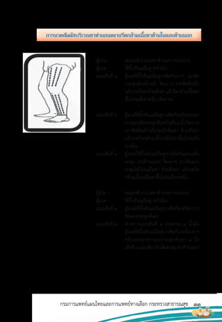 33
กรมการแพทย์แผนไทยและการแพทย์ทางเลือก กระทรวงสาธารณสุข
ผู้ป่วย : ตะแคงข้าง (นวดขาด้านนอก ท่อนล่าง)
ผู้นวด : ใช้นิ้วหัวแม่มือคู่ (คว�่ามือ)
แนวเส้นที่ 1 ผู้นวดใช้นิ้วหัวแม่มือคู่วางชิดกันเบาๆ แนวชิด
กระดูกสันหน้าแข้ง รีดเบาๆ จากชิดข้อเท้า
ไล่ไปจนถึงเข่าข้ามหัวเข่าแล้วรีดกล้ามเนื้อเข่า
ขึ้นไปจนถึงขาหนีบ (ดังภาพ)
แนวเส้นที่ 2 ผู้นวดใช้นิ้วหัวแม่มือคู่วางชิดกันขยับออกมา
จากแนวเส้นกระดูกสันหน้าแข้ง1นิ้วรีดเบาๆ
จากชิดข้อเท้าไล่ไปจนถึงข้อเข่า ข้ามหัวเข่า
แล้วกดรีดกล้ามเนื้อเหนือเข่าขึ้นไปจนถึง
ขาหนีบ
แนวเส้นที่ 3 ผู้นวดใช้นิ้วหัวแม่มือคู่วางชิดกันแนวเส้น
ตาตุ่ม (ขาด้านนอก) รีดเบาๆ จากชิดแนว
ตาตุ่มไล่ไปจนถึงเข่า ข้ามหัวเข่า แล้วกดรีด
กล้ามเนื้อเหนือเข่าขึ้นไปจนถึงขาหนีบ
ผู้ป่วย : ตะแคงข้าง (นวดขาด้านนอก ท่อนบน)
ผู้นวด : ใช้นิ้วหัวแม่มือคู่ (คว�่ามือ)
แนวเส้นที่ 1 ผู้นวดใช้นิ้วหัวแม่มือคู่วางชิดกันกดรีดเบาๆ
ชิดแนวกระดูกต้นขา
แนวเส้นที่ 2 ห่างจากแนวเส้นที่ 1 ประมาณ 1 นิ้วมือ
ผู้นวดใช้นิ้วหัวแม่มือคู่วางชิดกันกดรีดเบาๆ
ขยับออกมาจากแนวกระดูกต้นขา 1 นิ้ว
เส้นที่3แนวเดียวกับเส้นตาตุ่ม(ขาด้านนอก)
กำรนวดสัมผัสบริเวณขำท่ำนอนหงำยรีดกล้ำมเนื้อขำด้ำนในและด้ำนนอก
 