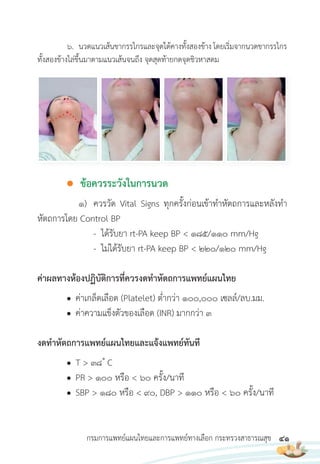 41
กรมการแพทย์แผนไทยและการแพทย์ทางเลือก กระทรวงสาธารณสุข
6. นวดแนวเส้นขากรรไกรและจุดใต้คางทั้งสองข้าง โดยเริ่มจากนวดขากรรไกร
ทั้งสองข้างไล่ขึ้นมาตามแนวเส้นจนถึง จุดสุดท้ายกดจุดชิวหาสดม
● ข้อควรระวังในการนวด
1) ควรวัด Vital Signs ทุกครั้งก่อนเข้าท�าหัตถการและหลังท�า
หัตถการโดย Control BP
- ได้รับยา rt-PA keep BP < 185/110 mm/Hg
- ไม่ได้รับยา rt-PA keep BP < 220/120 mm/Hg
ค่าผลทางห้องปฏิบัติการที่ควรงดท�าหัตถการแพทย์แผนไทย
● ค่าเกล็ดเลือด (Platelet) ต�่ากว่า 100,000 เซลล์/ลบ.มม.
● ค่าความแข็งตัวของเลือด (INR) มากกว่า 3
งดท�าหัตถการแพทย์แผนไทยและแจ้งแพทย์ทันที
● T > 38 � C
● PR > 100 หรือ < 60 ครั้ง/นาที
● SBP > 180 หรือ < 90, DBP > 110 หรือ < 60 ครั้ง/นาที
 