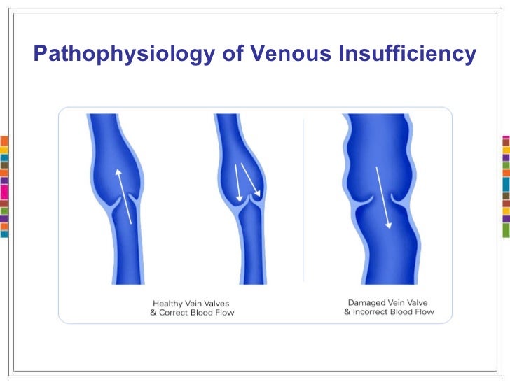 Clinical manifestations venous stasis ulcer