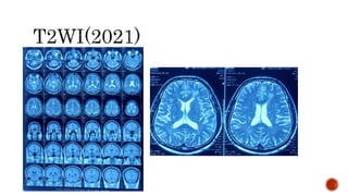 Clinical presentation on multiple sclerosis | PPTX