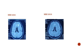 Clinical presentation on multiple sclerosis | PPTX