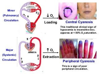 ↑ O2
Extraction
↓ O2
Loading
Minor
(Pulmonary)
Circulation
Major
(Systemic)
Circulation
Central Cyanosis
This traditional clinical sign of
hypoxemia is insensitive bec.
apperas at < 80% O2 saturation.
Peripheral Cyanosis
This is a sign of poor
peripheral circulation.
 