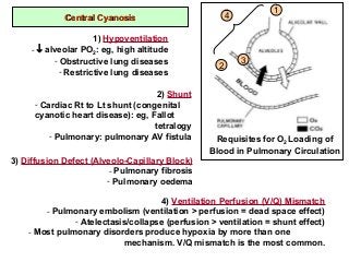Central CyanosisCentral Cyanosis
1
2
3
4
1) Hypoventilation
- ↓ alveolar PO2
: eg, high altitude
- Obstructive lung diseases
- Restrictive lung diseases
2) Shunt
- Cardiac Rt to Lt shunt (congenital
cyanotic heart disease): eg, Fallot
tetralogy
- Pulmonary: pulmonary AV fistula
3) Diffusion Defect (Alveolo-Capillary Block)
- Pulmonary fibrosis
- Pulmonary oedema
4) Ventilation Perfusion (V/Q) Mismatch
- Pulmonary embolism (ventilation > perfusion = dead space effect)
- Atelectasis/collapse (perfusion > ventilation = shunt effect)
- Most pulmonary disorders produce hypoxia by more than one
mechanism. V/Q mismatch is the most common.
Requisites for O2 Loading of
Blood in Pulmonary Circulation
 