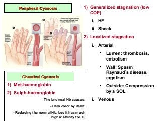 Peripheral CyanosisPeripheral Cyanosis 1) Generalized stagnation (low
COP)
i. HF
ii. Shock
2) Localized stagnation
i. Arterial
• Lumen: thrombosis,
embolism
• Wall: Spasm:
Raynaud`s disease,
ergotism
• Outside: Compression
by a SOL
i. Venous
Chemical CyanosisChemical Cyanosis
1) Met-haemoglobin
2) Sulph-haemoglobin
The bnormal Hb causes:
- Dark color by itself.
- Reducing the normal Hb, bec it has much
higher affinity for O2
 