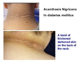 Acanthosis Nigricans
In diabetes mellitus
A band of
thickened
darkened skin
on the back of
the neck.
 