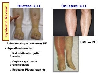 Bilateral OLL Unilateral OLL
DVT → PE• Pulmonary hypertension → HF
• Hypoalbuminaemia:
o Malnutrition in cystic
fibrosis
o Copious sputum in
bronchiectasis
o Repeated Pleural tapping
SystemicReview
 