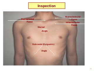 33
Supraclavicular
Fossa
Infraclavicular
Fossa
Suprasternal
Fossa
Sternal
Angle
Subcostal (Epigastric)
Angle
Inspection
 