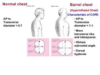 Normal chest Barrel chest
(Hyperinflated Chest)
AP to
Transverse
diameter = 5:7
• AP to
Transverse
diameter = 1:1
• More
transverse ribs
and interspaces
• Obtuse
subcostal angle
• Dorsal
kyphosis
Characteristic of COPD
 