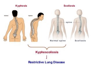 Kyphosis Scoliosis
Kyphoscoliosis
Restrictive Lung Disease
 