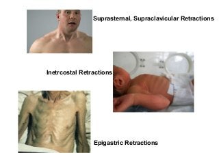 Suprasternal, Supraclavicular Retractions
Epigastric Retractions
Inetrcostal Retractions
 