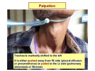 Palpation
Trachea is markedly shifted to the left
It is either pushed away from Rt side (pleural effusion
or pneumothorax) or pulled to the Lt side (pulmonary
atelectasis or fibrosis).
 
