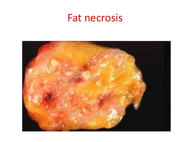 Icd 10 Code For Fat Necrosis Of Breast