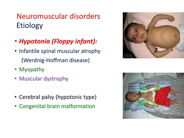 Clinical presentation of neurological diseases in children 2021 | PDF