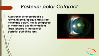 CLINICAL Presentaton OF CATARACTS-4.pptx