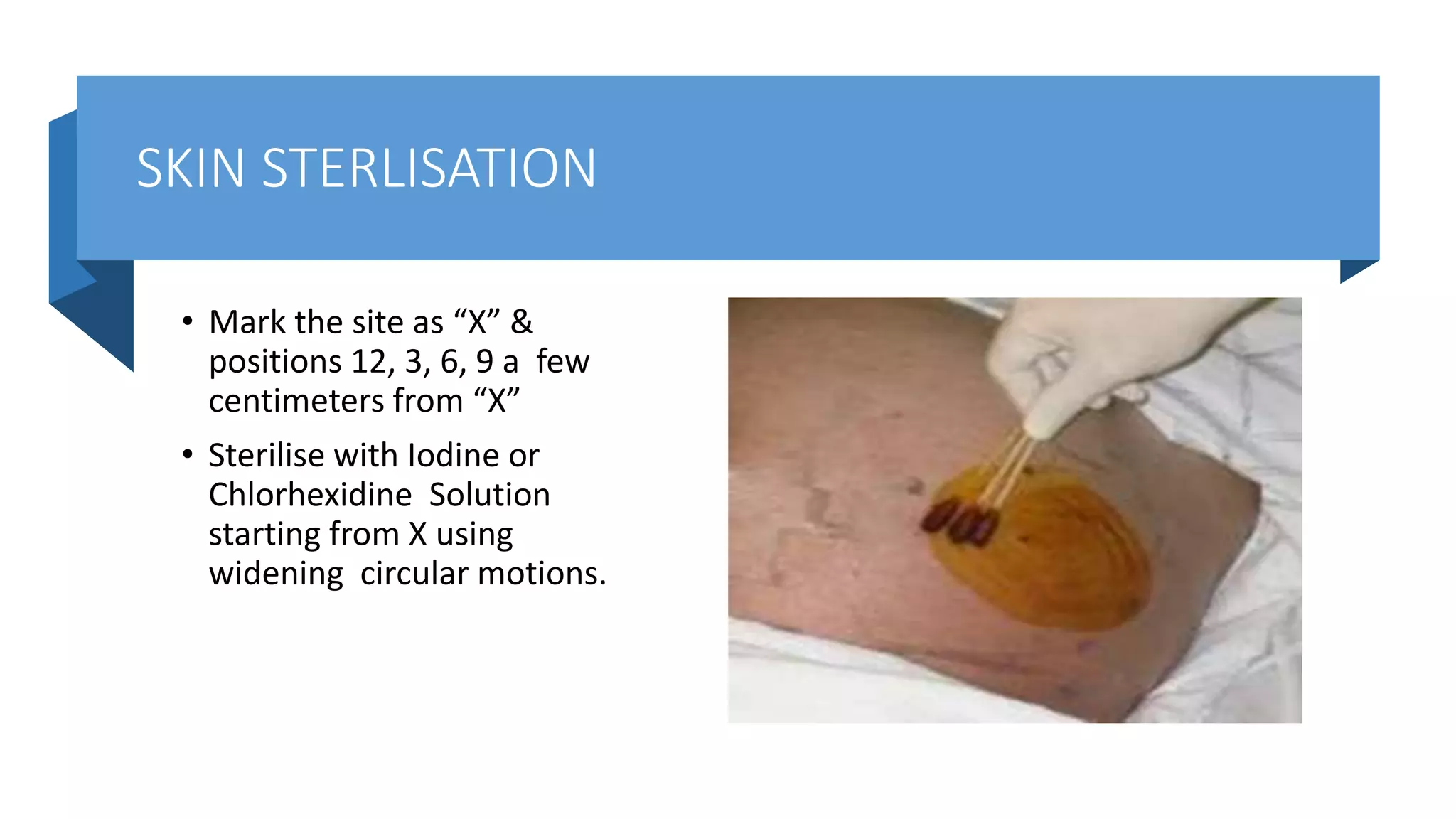 SKIN STERLISATION
• Mark the site as “X” &
positions 12, 3, 6, 9 a few
centimeters from “X”
• Sterilise with Iodine or
Chlorhexidine Solution
starting from X using
widening circular motions.
 