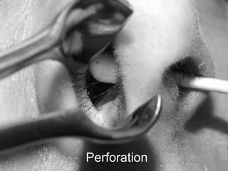 Perforation
 