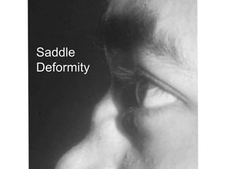 Saddle
Deformity
 
