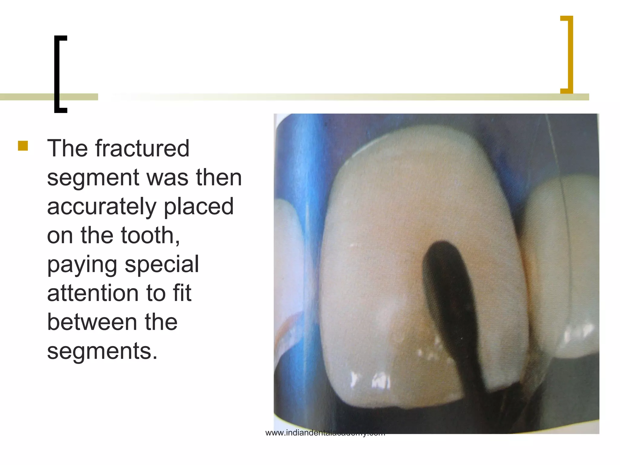 Clinical procedures for the immediate reattachment jc / dental implant